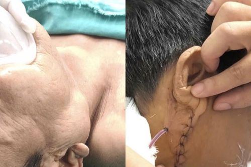 Phẫu thuật cắt bỏ u tuyến nước bọt mang tai cho bệnh nhân