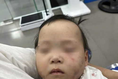 Bé gái 1 tuổi bị bầm tím mặt khi gửi nhà trẻ ở Bắc Ninh: Công an tạm giữ cô giáo