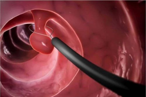 Polyp đại tràng có thành ung thư?