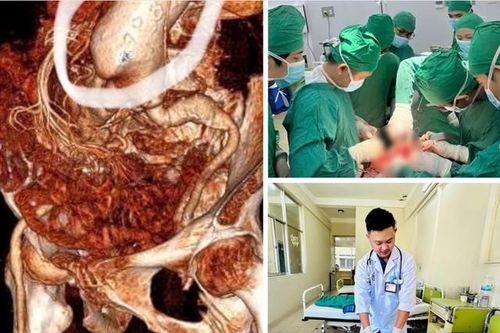 Phẫu thuật cứu sống kịp thời bệnh nhân 86 tuổi vỡ phình động mạch chủ bụng
