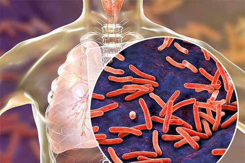 Dự phòng lao tiềm ẩn – 'lá chắn' quan trọng cho người đang điều trị ARV