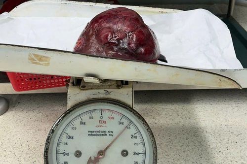 Đau tức vùng bụng, phát hiện u gan khổng lồ 18,6 cm, phải cắt 2 lần mới hết