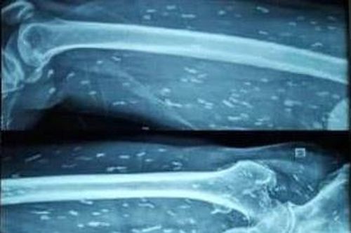 Triệu chứng cảnh báo giun sán ẩn náu khắp cơ thể