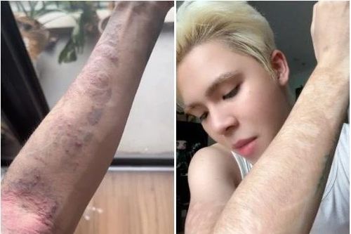 Chơi hình xăm dán, nam TikToker bị dị ứng nghiêm trọng