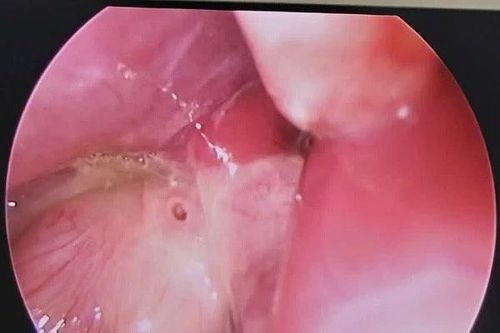 Cảnh báo nguy cơ thủng dạ dày ở trẻ em ngày càng tăng