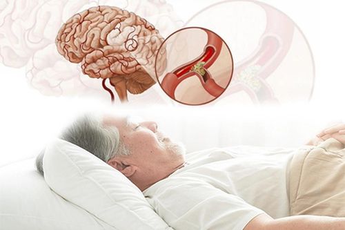Cảnh báo nguy cơ đột tử do ngủ ngáy kéo dài