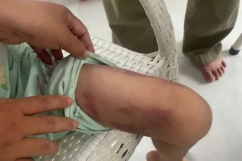 Bắt tạm giam hai đối tượng trong vụ bé 9 tuổi bị mẹ ruột bạo hành