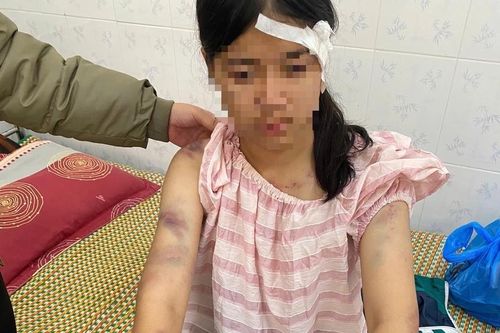 Hội Bảo vệ Quyền trẻ em yêu cầu xử lý nghiêm vụ bé gái 13 tuổi bị người thân tra tấn ở Thái Nguyên
