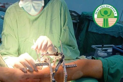 Thiểu xương mác dẫn tới hàng loạt biến dạng ở chi dưới