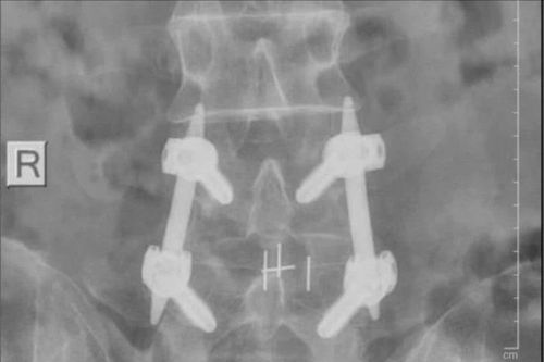 Điều trị thoát vị đĩa đệm bằng phương pháp bắt vít qua da