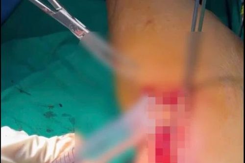 Báo động đỏ tiêm truyền tại cơ sở không đảm bảo gây áp xe nghiêm trọng