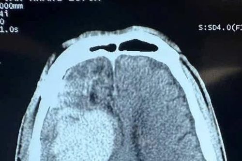 Chấn thương sọ não sau lên cơn động kinh, cách gì phát hiện sớm?