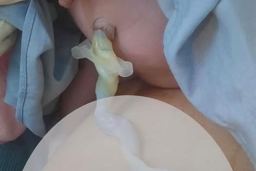 Xử trí thành công trường hợp sinh thường có dây rốn thắt nút hiếm gặp