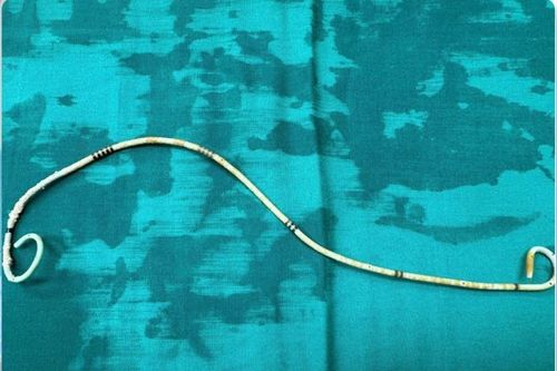 Sỏi bám dày đặc quanh ống sonde JJ bị bỏ quên 3 năm