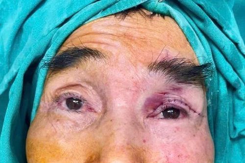 Tạo hình vạt cơ trán chữa mắt bị 'che rèm' từ thuở lọt lòng ở cụ ông 65 tuổi