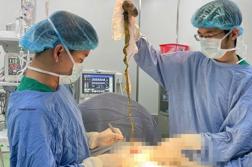 Phẫu thuật lấy búi tóc khổng lồ chiếm trọn dạ dày bé trai ở Đà Nẵng