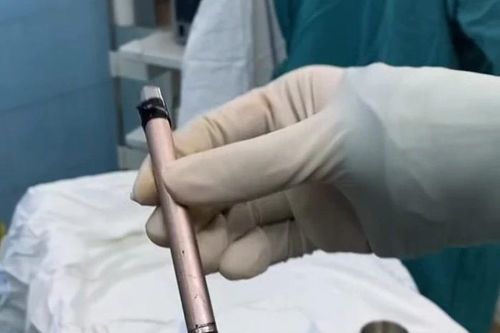 Gắp thành công cây bút bị mắc kẹt trong bàng quang của một thiếu nữ