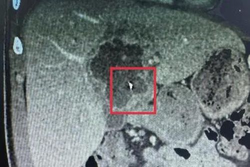 Vĩnh Long: Phẫu thuật lấy kim may đồ 6cm trong gan của bệnh nhân