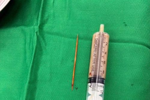 Phẫu thuật cứu bệnh nhân nuốt tăm tre xuyên tá tràng, đâm thủng thận