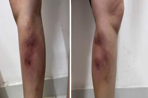 Cận cảnh đôi chân của cô gái 29 tuổi sau tiêm filler thẳng chân tại nhà