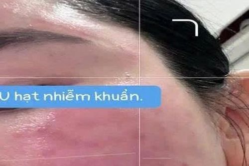 Người phụ nữ mọc u hạt, phù nề toàn bộ mặt sau 2 ngày tiêm meso