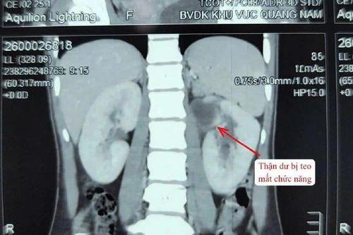 Kỳ lạ cô gái 22 tuổi có 3 quả thận