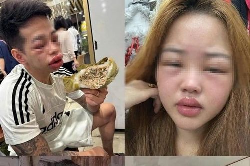 Nhiều người sưng phù mặt sau khi ăn bánh trứng kiến: Bác sĩ cảnh báo khẩn