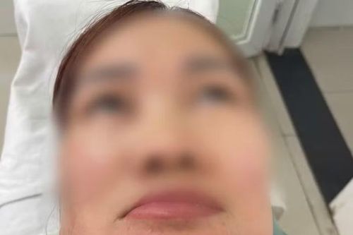 Người phụ nữ 37 tuổi mặt sưng vù, không ăn uống được vì tự ý nặn mụn