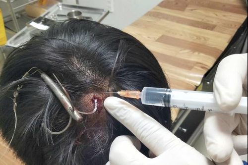 Móc câu 3 tiêu cắm sâu vào đỉnh đầu thiếu niên