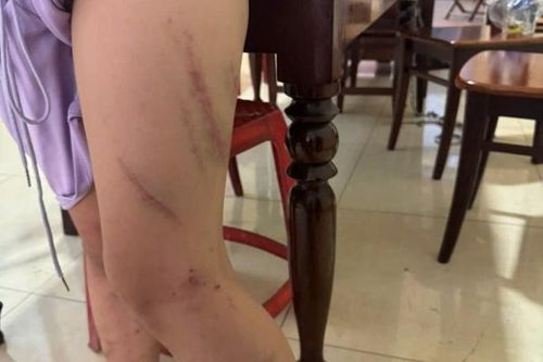Công an xác minh vụ bé gái 9 tuổi bị đánh chi chít vết thương trên người
