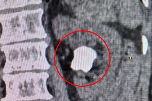 Xử trí sỏi thận lớn 4cm cho cụ ông 71 tuổi bằng kỹ thuật tán sỏi qua da