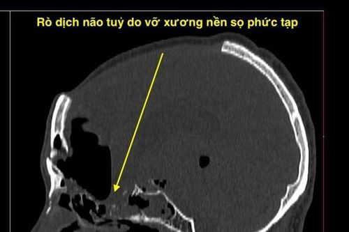 Nội soi nền sọ não vá rò dịch não tủy qua đường mũi