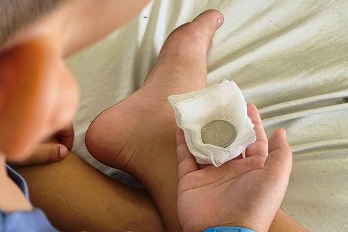 Kịp thời cứu bé trai 7 tuổi nuốt đồng xu đồ chơi mắc thực quản