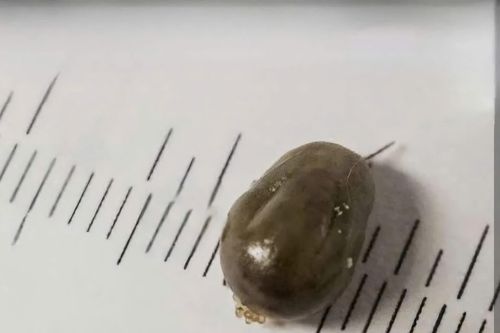 Phát hiện ve chó làm tổ trong ống tai bé 7 tuổi