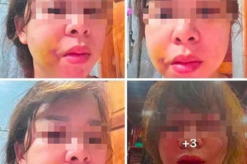Người phụ nữ cầu cứu sau nhiều lần bị chồng hành hung