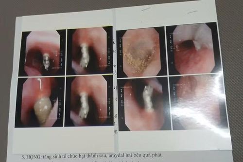 Niềng răng, vít chọc thẳng vào xoang mũi bệnh nhân, bệnh viện nói gì?