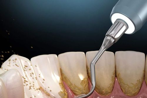 Vì sao nên lấy vôi răng thường xuyên?