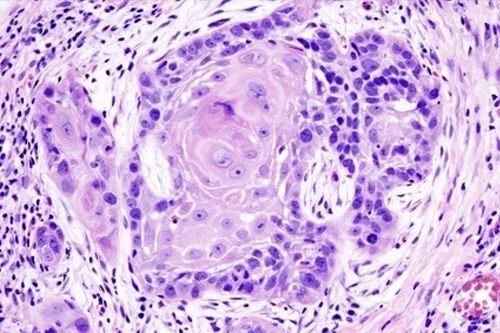 Thuốc amivantamab 'xóa sổ' khối u ung thư đầu cổ bằng cách nào?