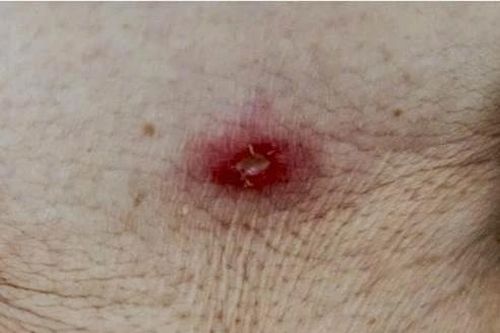 Cụ bà 88 tuổi nhiễm trùng toàn thân vì sốt mò từ vết đốt nhỏ