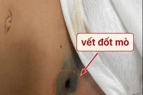 Sốt 5 ngày, bé gái 2 tuổi thoát khỏi sốc nhiễm khuẩn nhờ phát hiện vết đốt mò
