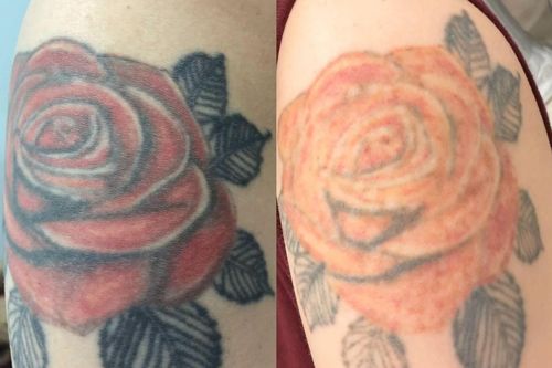Từ chuyện Võ Hà Linh, bác sĩ nói điều nhiều người hối hận khi xăm