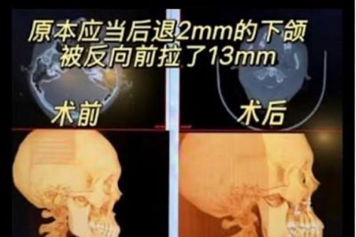 Cô gái Trung Quốc bị biến dạng khuôn mặt sau phẫu thuật chỉnh hàm