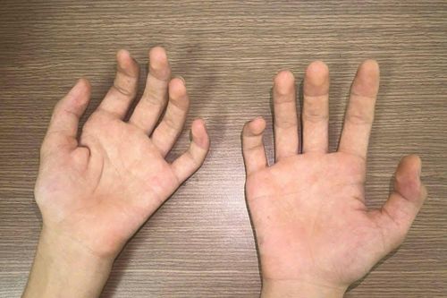 Teo cơ bàn tay ở người trẻ: Cảnh giác với bệnh Hirayama hiếm gặp