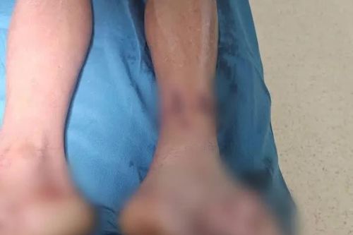 Đắp cả gói bột ngọt vào vết thương, ngư dân suýt phải cắt cụt cẳng chân