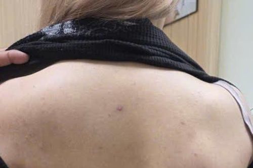 Phẫu thuật thành công cho bệnh nhân bị vẹo cột sống tới 76 độ
