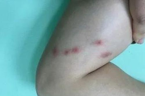 Ba nốt đỏ xếp thành hàng, dấu hiệu không nên bỏ qua