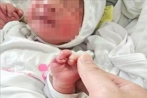 Phẫu thuật thành công cho trẻ sơ sinh bị vòng xơ thắt nghẹt chi