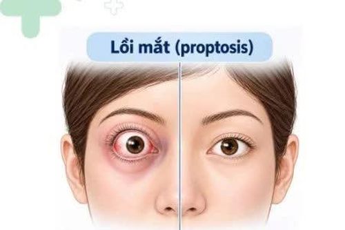 Mắt lồi, mất dần thị lực do khối u nằm sâu sau nhãn cầu