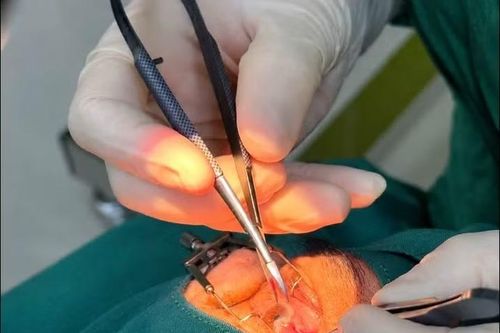 Nhiều ca mộng thịt nặng được xử lý, cẩn trọng nguy cơ bệnh nền