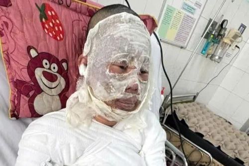 Mở rộng lòng từ: Bị bỏng nặng không tiền điều trị
